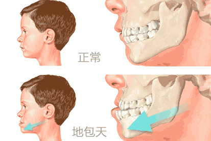 兒童地包天什么時候治療更好
