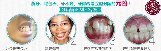 為什么說(shuō)矯正牙齒要拔牙