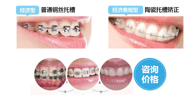 成人牙齒矯正較佳時期是什么？