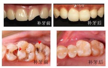 拔牙補牙一般多少錢?