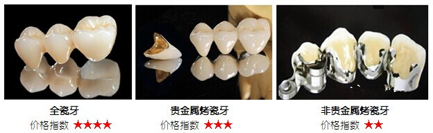 全瓷牙的優缺點全瓷牙的優缺點