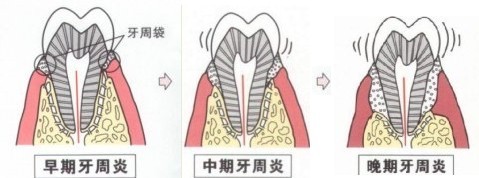 牙周炎一般疼幾天