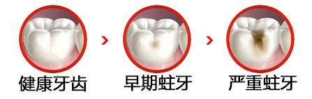 補一個牙洞要多少錢