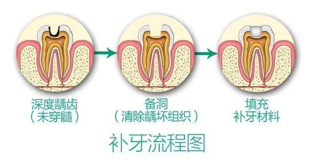 補牙的流程